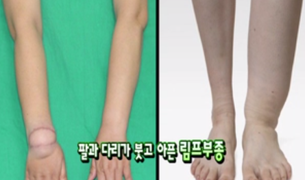 림프 부종과 재활치료