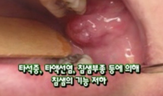 침샘내시경