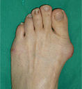 무지외반증 사진1