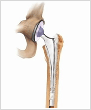 인공관절 사진1