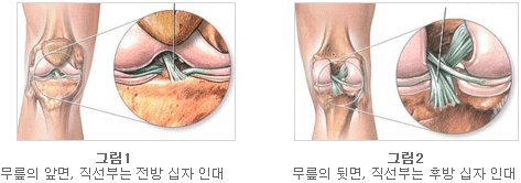 십자인대파열 사진1
