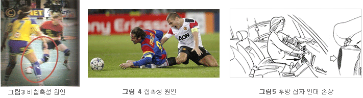 십자인대파열 사진2