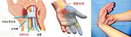 손목터널증후군 사진1