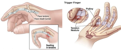 손목터널증후군 사진2